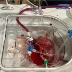 پیوند اولین کلیه هیبریدی انسان خوک در اسپانیا