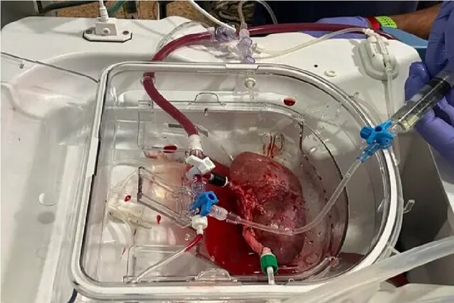 پیوند اولین کلیه هیبریدی انسان خوک در اسپانیا