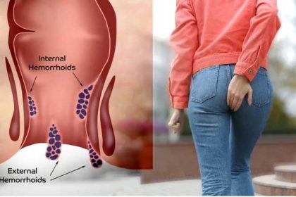 درمان قطعی بواسیر با لیزر؛ پایان دردهای همیشگی در بیماری های نشیمنگاهی